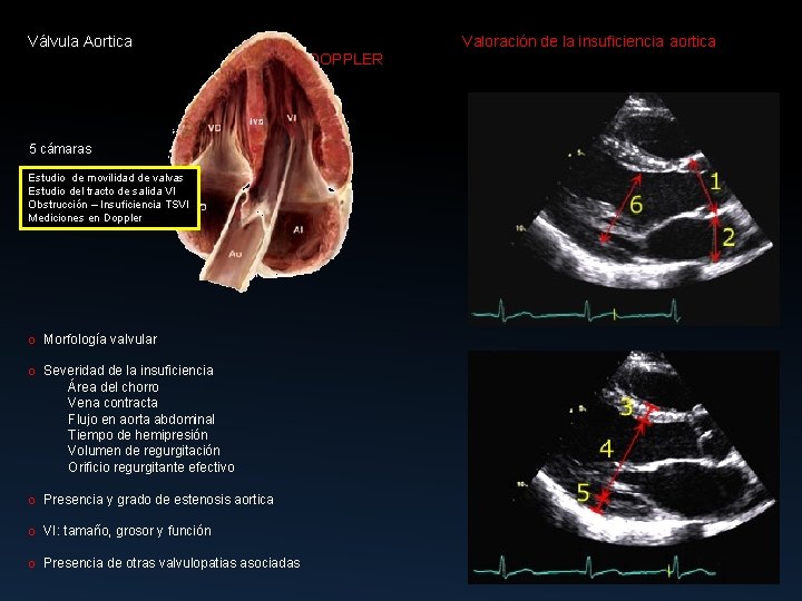 Válvula Aortica Valoración de la insuficiencia aortica DOPPLER 5 cámaras Estudio de movilidad de