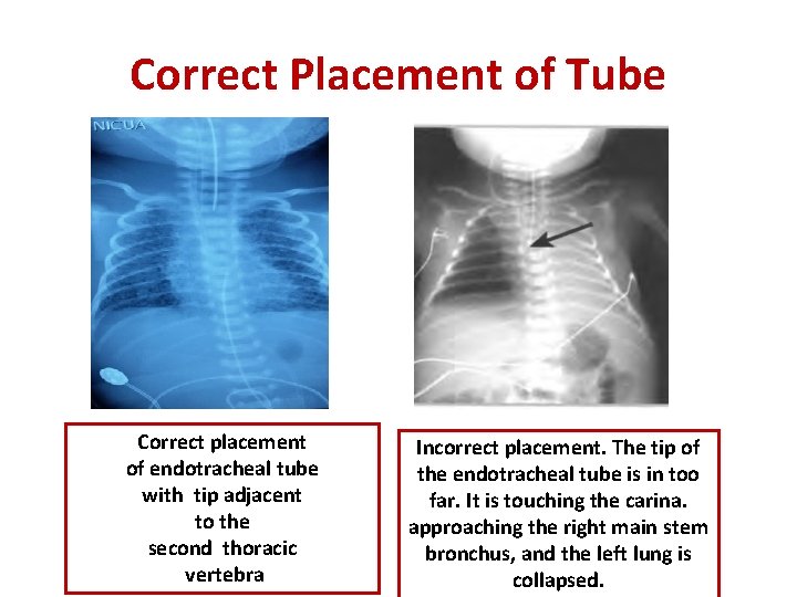 Correct Placement of Tube Correct placement of endotracheal tube with tip adjacent to the