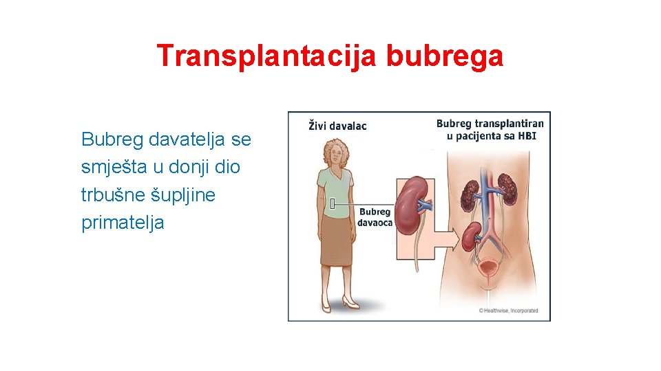 Transplantacija bubrega Bubreg davatelja se smješta u donji dio trbušne šupljine primatelja 