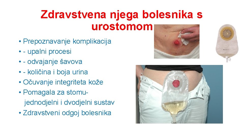 Zdravstvena njega bolesnika s urostomom • Prepoznavanje komplikacija • - upalni procesi • -