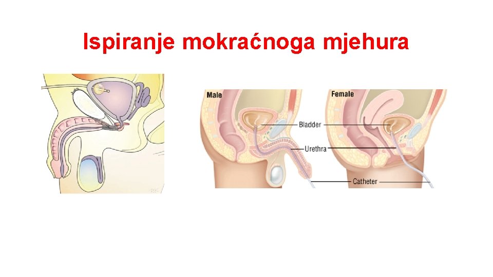 Ispiranje mokraćnoga mjehura 