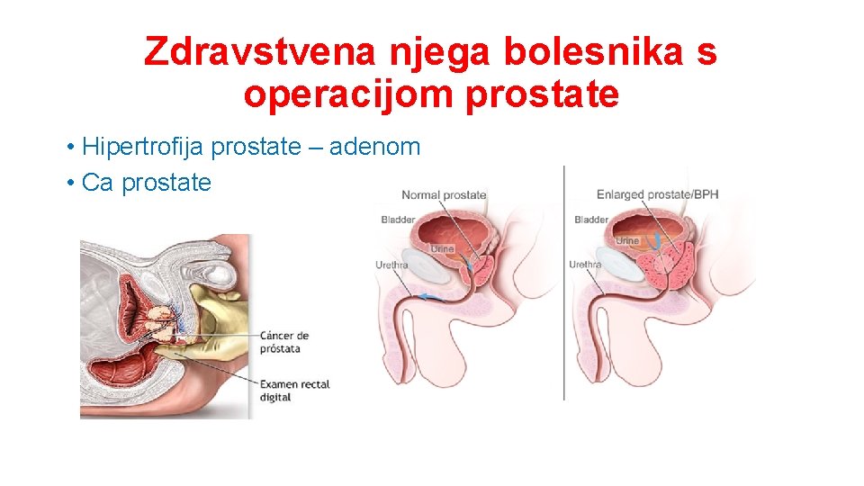 Zdravstvena njega bolesnika s operacijom prostate • Hipertrofija prostate – adenom • Ca prostate