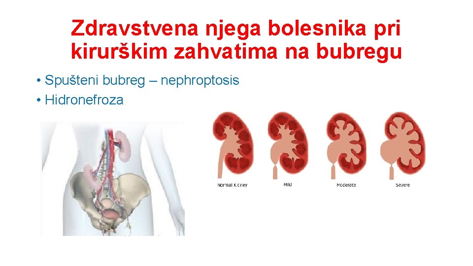 Zdravstvena njega bolesnika pri kirurškim zahvatima na bubregu • Spušteni bubreg – nephroptosis •