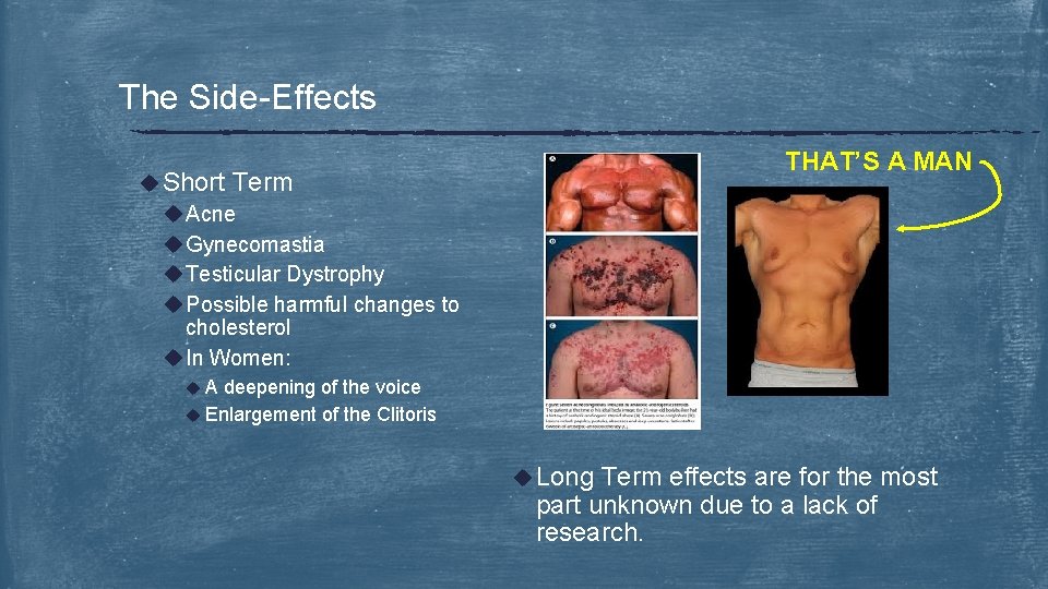 The Side-Effects THAT’S A MAN u Short Term u Acne u Gynecomastia u Testicular