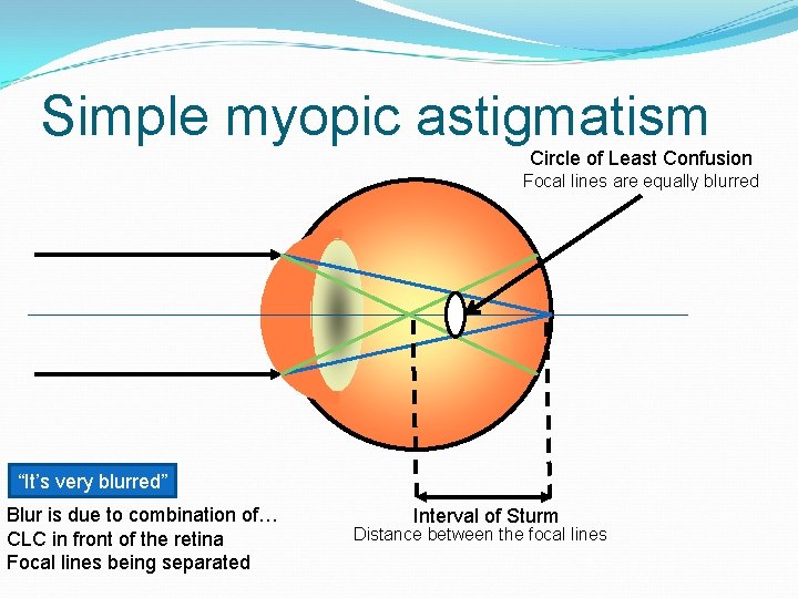 Simple myopic astigmatism Circle of Least Confusion Focal lines are equally blurred “It’s very