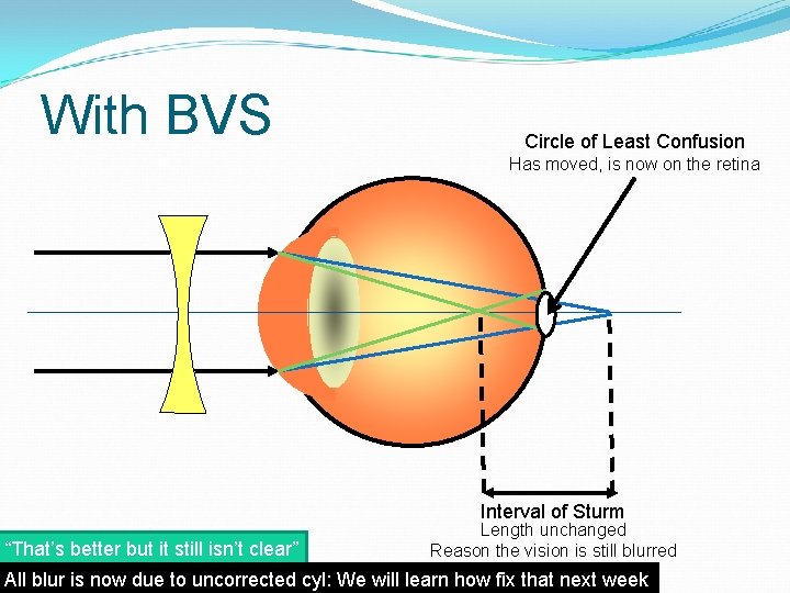 With BVS Circle of Least Confusion Has moved, is now on the retina Interval