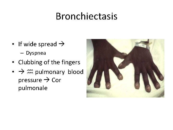 Bronchiectasis • If wide spread – Dyspnea • Clubbing of the fingers • h