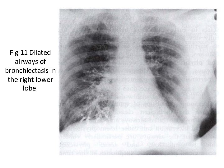 Fig 11 Dilated airways of bronchiectasis in the right lower lobe. 