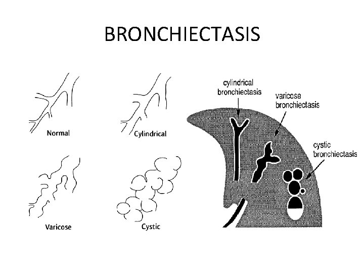 BRONCHIECTASIS 