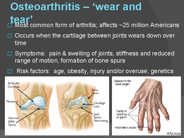 Osteoarthritis – ‘wear and tear’ � Most common form of arthritis; affects ~25 million