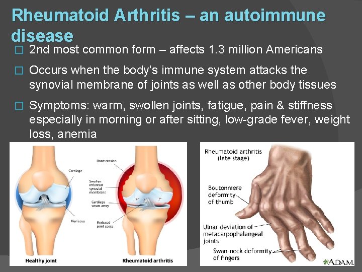 Rheumatoid Arthritis – an autoimmune disease � 2 nd most common form – affects
