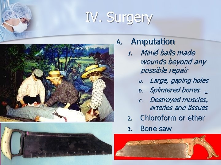 IV. Surgery A. Amputation 1. Minié balls made wounds beyond any possible repair Large,