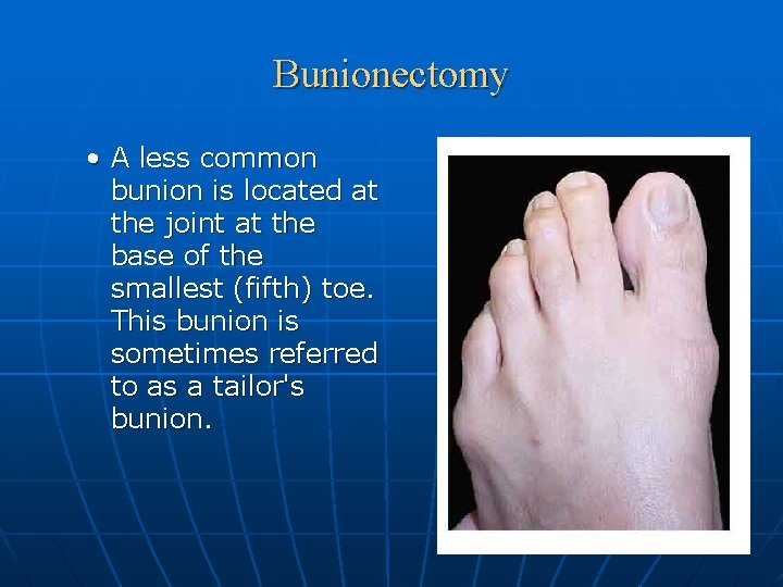 Bunionectomy • A less common bunion is located at the joint at the base