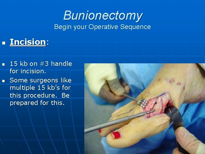 Bunionectomy Begin your Operative Sequence n n n Incision: 15 kb on #3 handle