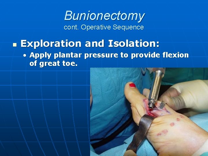 Bunionectomy cont. Operative Sequence n Exploration and Isolation: • Apply plantar pressure to provide