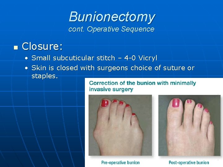 Bunionectomy cont. Operative Sequence n Closure: • Small subcuticular stitch – 4 -0 Vicryl