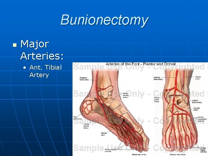 Bunionectomy n Major Arteries: • Ant. Tibial Artery 