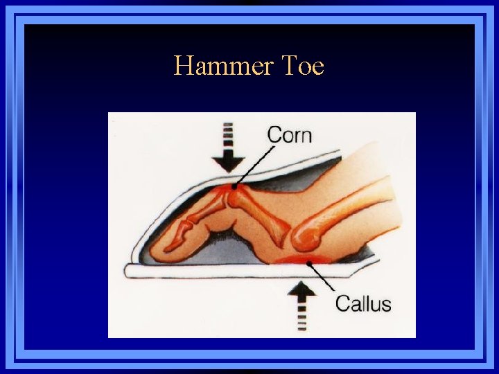 Hammer Toe 