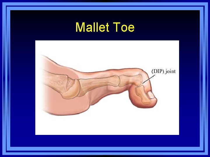 Mallet Toe 
