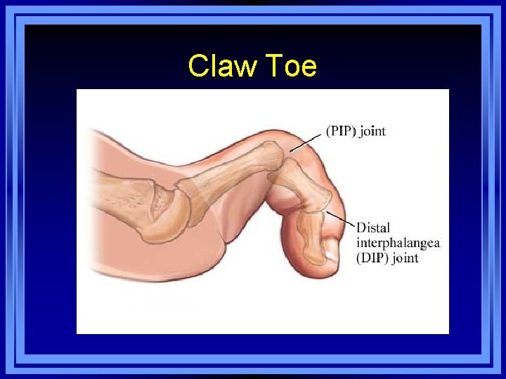 Claw Toe 