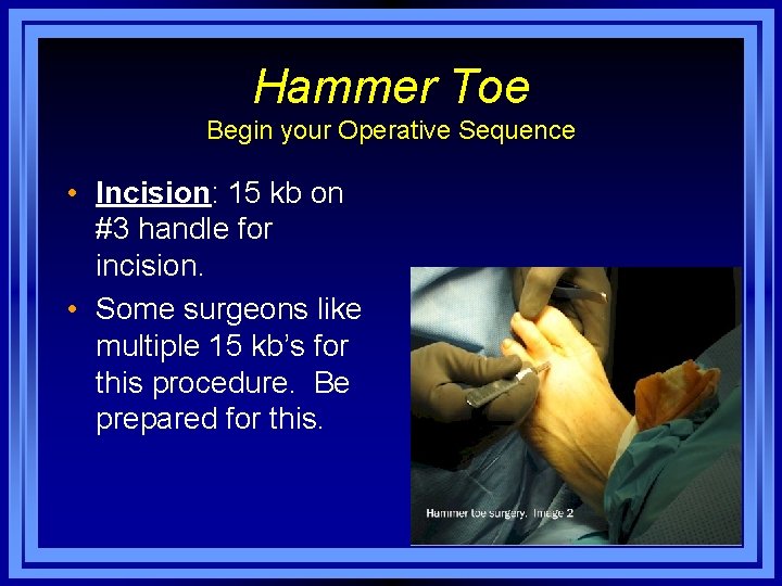 Hammer Toe Begin your Operative Sequence • Incision: 15 kb on #3 handle for