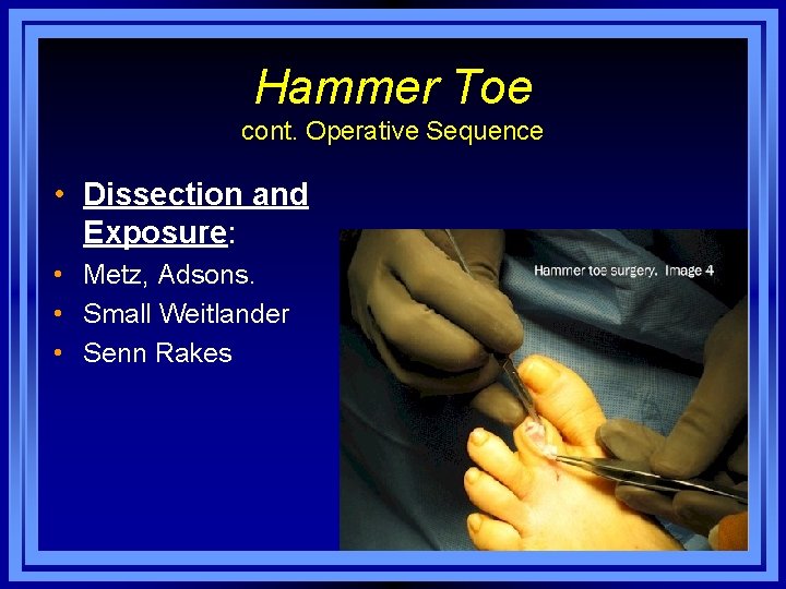 Hammer Toe cont. Operative Sequence • Dissection and Exposure: • Metz, Adsons. • Small