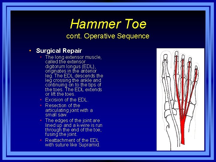 Hammer Toe cont. Operative Sequence • Surgical Repair • The long extensor muscle, called