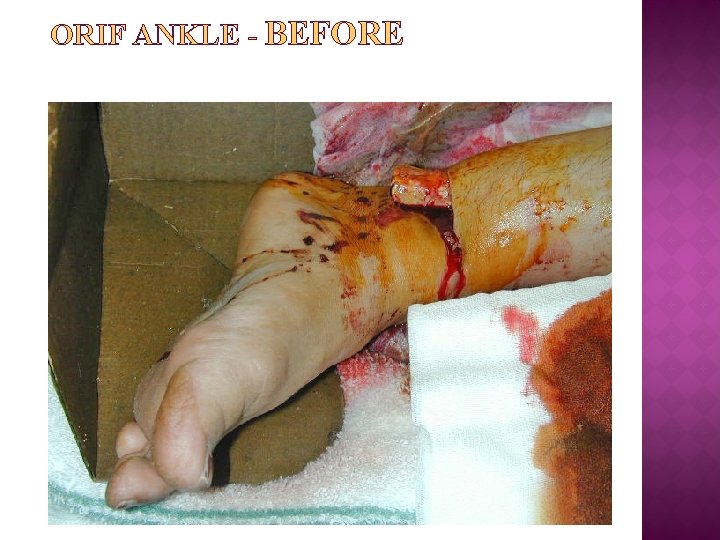 ORIF ANKLE - BEFORE 