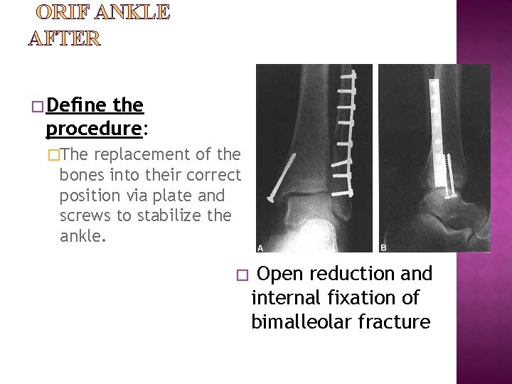 ORIF ANKLE AFTER � Define the procedure: �The replacement of the bones into their