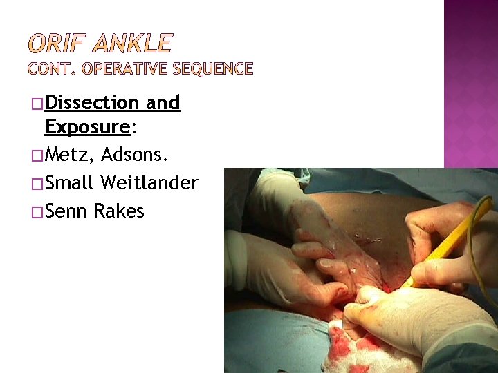 �Dissection and Exposure: �Metz, Adsons. �Small Weitlander �Senn Rakes 
