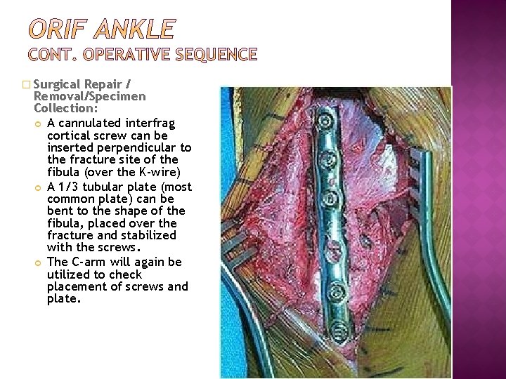 � Surgical Repair / Removal/Specimen Collection: A cannulated interfrag cortical screw can be inserted