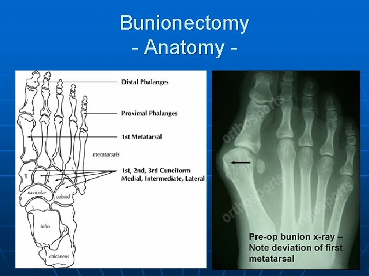 Bunionectomy - Anatomy - 