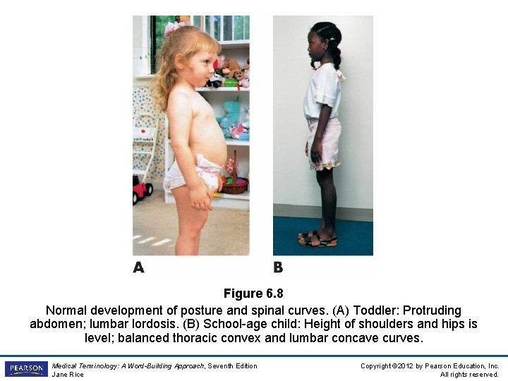 Figure 6. 8 Normal development of posture and spinal curves. (A) Toddler: Protruding abdomen;