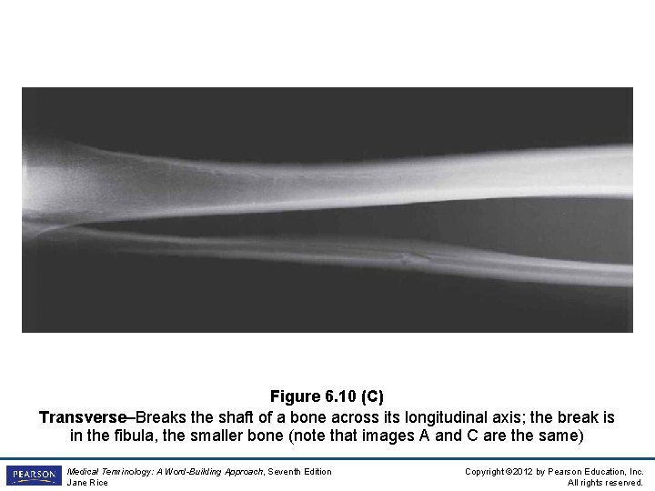 Figure 6. 10 (C) Transverse–Breaks the shaft of a bone across its longitudinal axis;