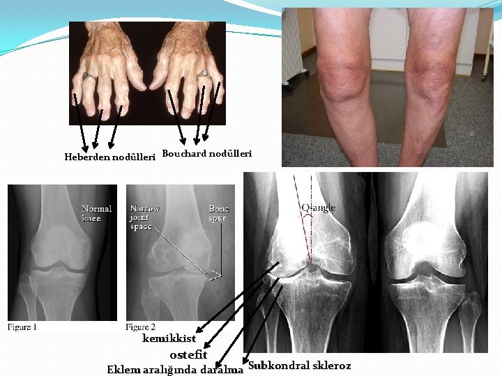 Heberden nodülleri Bouchard nodülleri kemikkist ostefit Eklem aralığında daralma Subkondral skleroz 