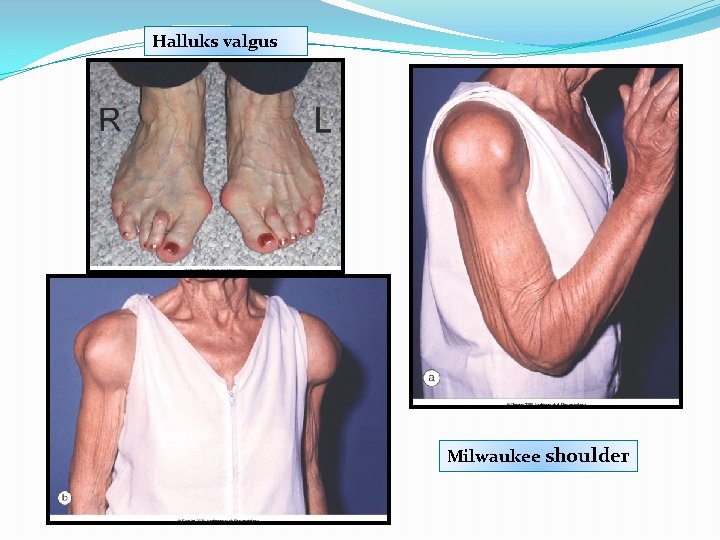 Halluks valgus Milwaukee shoulder 