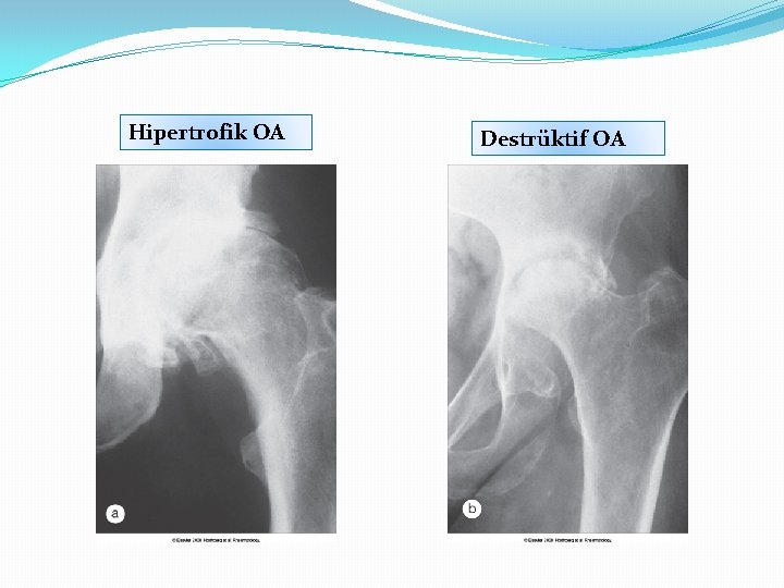 Hipertrofik OA Destrüktif OA 
