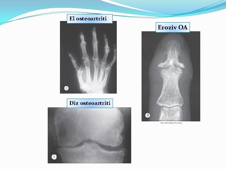 El osteoartriti Eroziv OA Diz osteoartriti 