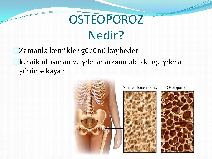 OSTEOPOROZ Nedir? �Zamanla kemikler gücünü kaybeder �kemik oluşumu ve yıkımı arasındaki denge yıkım yönüne