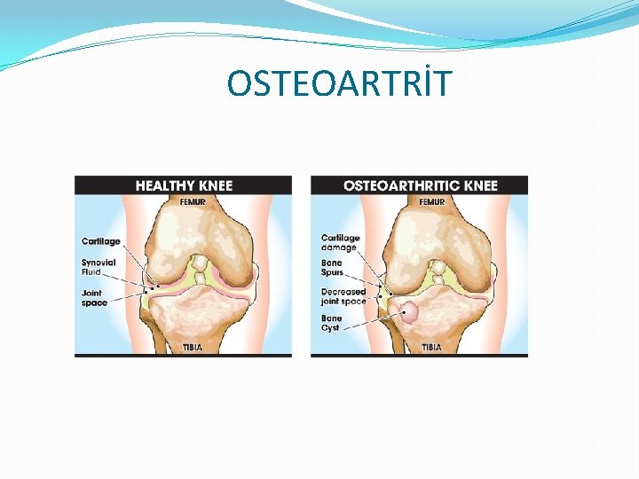 OSTEOARTRİT 