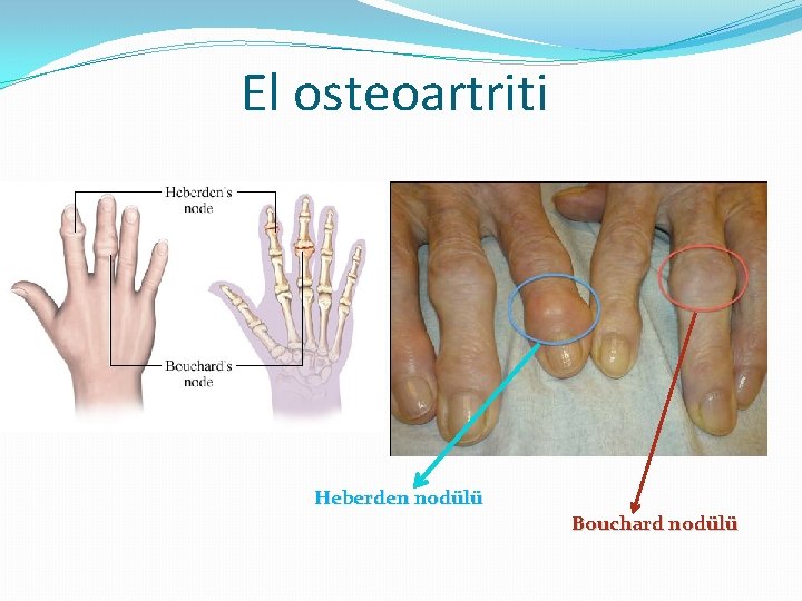 El osteoartriti Heberden nodülü Bouchard nodülü 