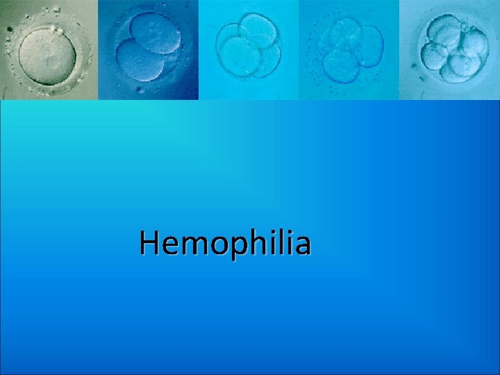 Hemophilia 