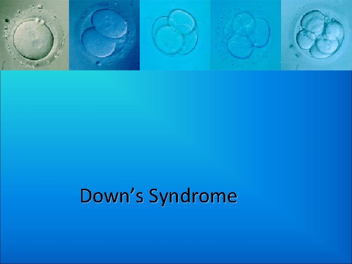Down’s Syndrome 