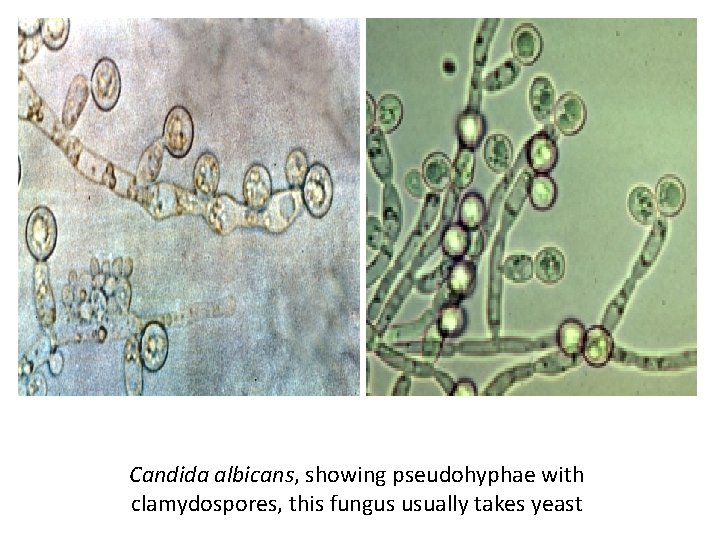 Candida albicans, showing pseudohyphae with clamydospores, this fungus usually takes yeast 