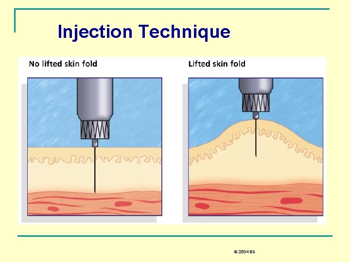 Injection Technique © 2004 BD 