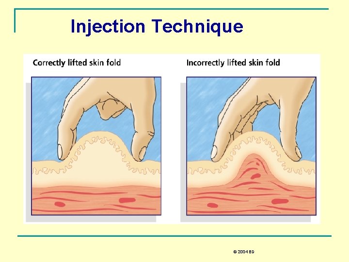 Injection Technique © 2004 BD 