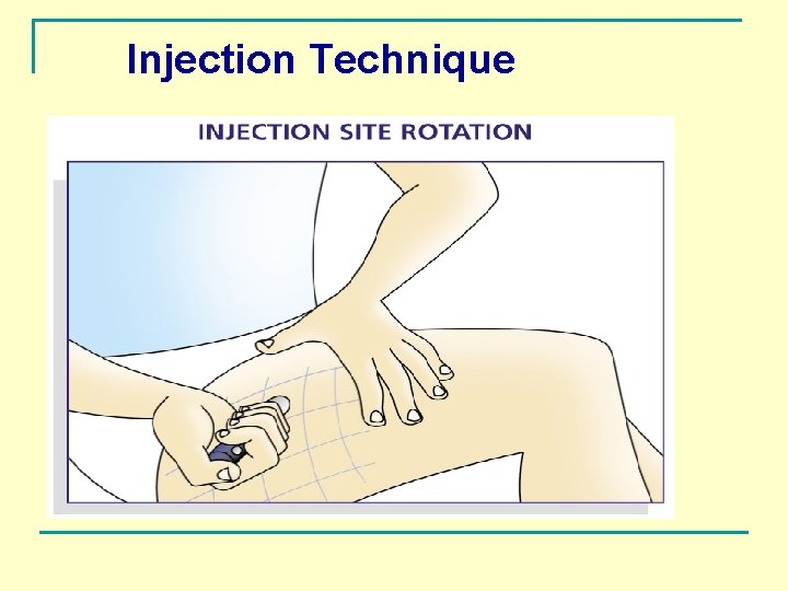 Injection Technique 