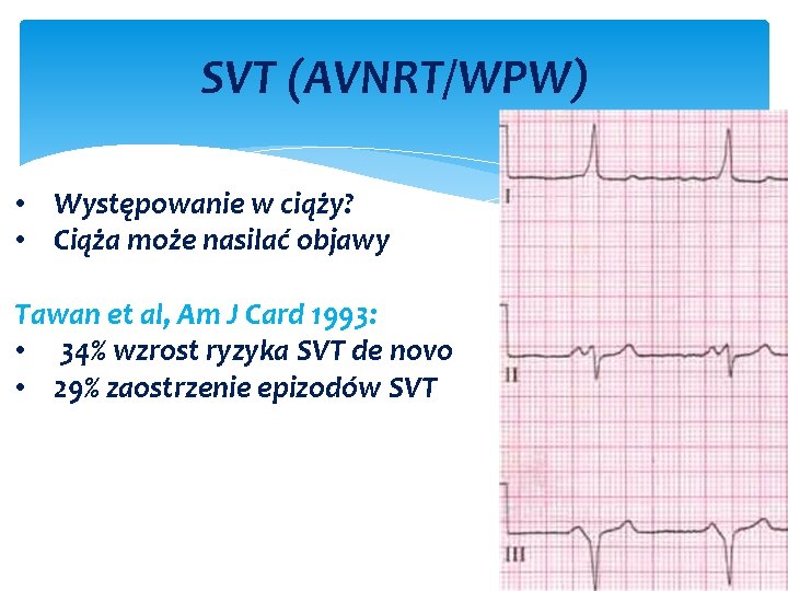 SVT (AVNRT/WPW) • Występowanie w ciąży? • Ciąża może nasilać objawy Tawan et al,