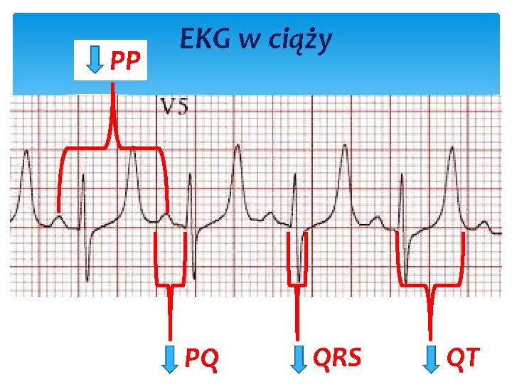 PP EKG w ciąży PQ QRS QT 