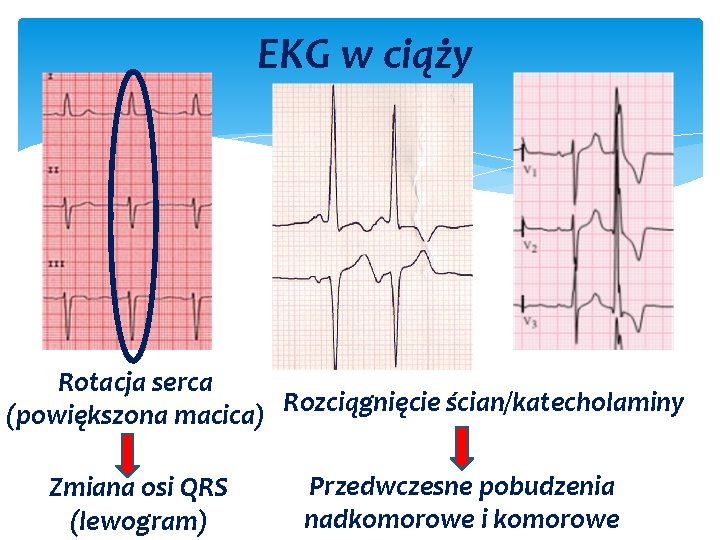 EKG w ciąży Rotacja serca Rozciągnięcie ścian/katecholaminy (powiększona macica) Zmiana osi QRS (lewogram) Przedwczesne